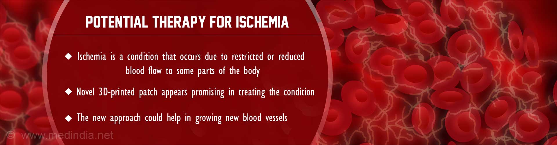 Potential therapy for ischemia
- Ischemia is a condition that occurs due to restricted or reduced blood flow to some parts of the body
- Novel 3D-printed patch appears promising in treating the condition
- The new approach could help in growing new blood vessels