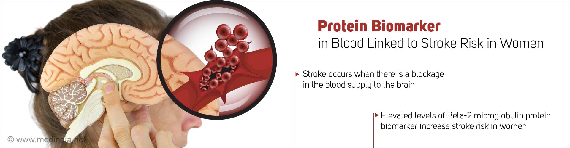 Protein Biomarker Linked to Stroke Risk in Women