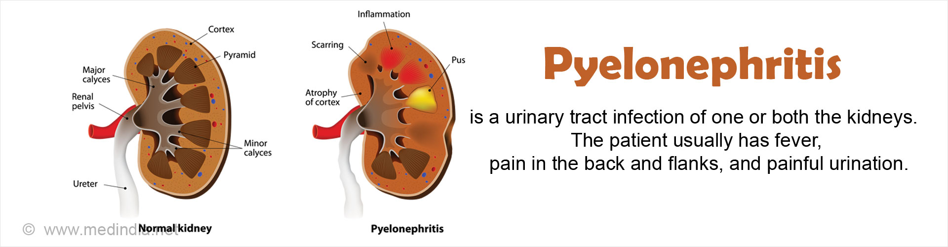 Pyelonephritis is a urinary tract infection of one or both the kidneys. The patient usually has high fever, pain in the back, flanks and painful urination