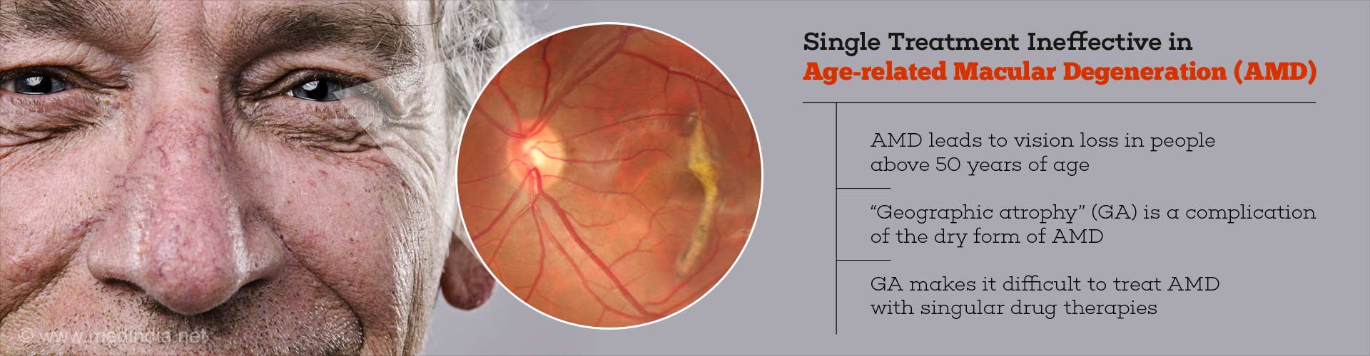 Single treatment ineffective in Age-related Macular Degeneration (AMD)
- AMD leads to vision loss in people above 50 years of age
- 