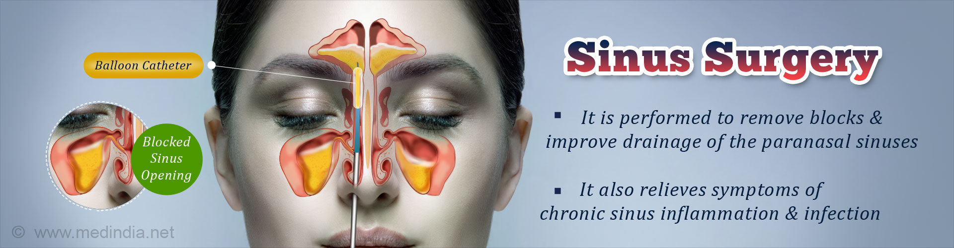 Sinus Surgery