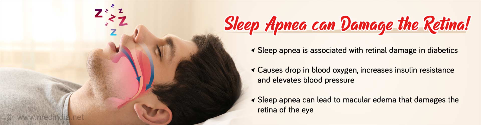 Sleep apnea can damage the retina. Sleep apnea is associated with retinal damage in diabetics. It causes drop in blood oxygen, increases insulin resistance and elevates blood pressure. Sleep apnea can lead to macular edema that damages the retina of the eye.