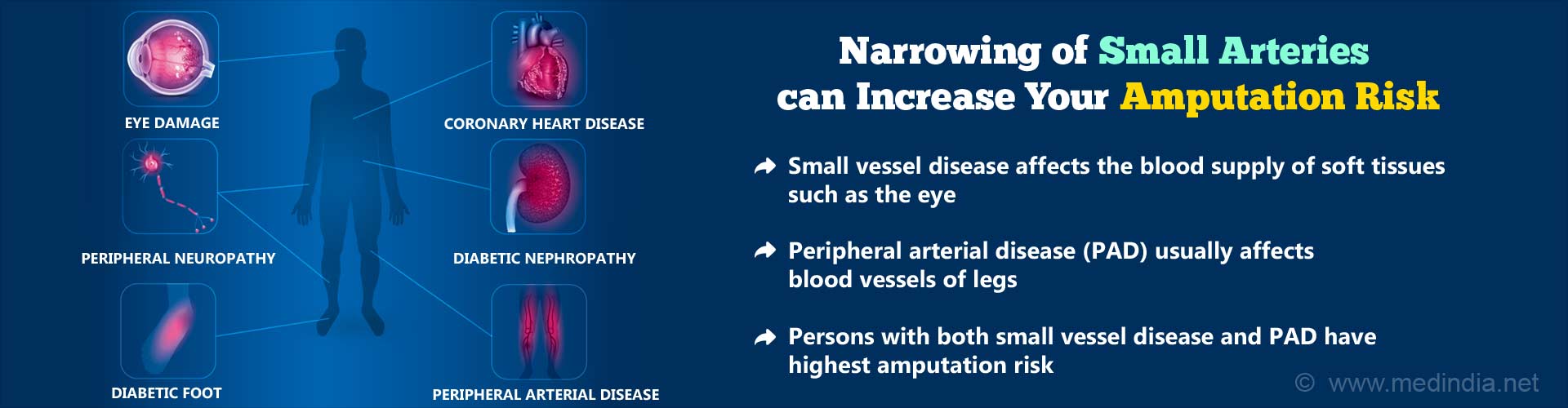 Narrowing of small arteries can increase your amputation risk. Small vessel disease affects the blood supply of soft tissues such as the eye. Peripheral arterial disease (PAD) usually affects blood vessels of legs. Persons with both small vessel disease and PAD have highest amputation risk.
