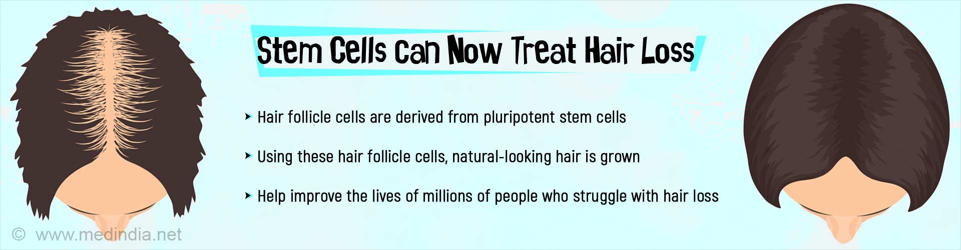 Stem cells can now treat hair loss. Hair follicle cells are derived from pluripotent stem cells. Using these hair follicle cells, natural-looking hair is grown. Helps improve the lives of millions of people who struggle with hair loss.
