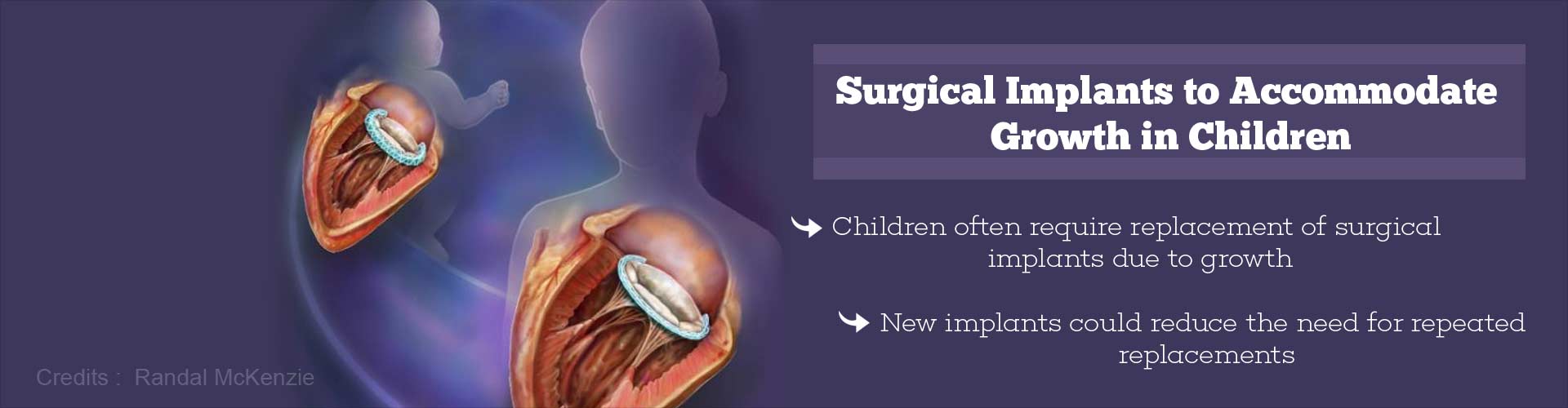 Surgical implants to accommodate growth in children
- Children often require replacement of surgical implants due to growth
- New implants could reduce the need for repeated replacements