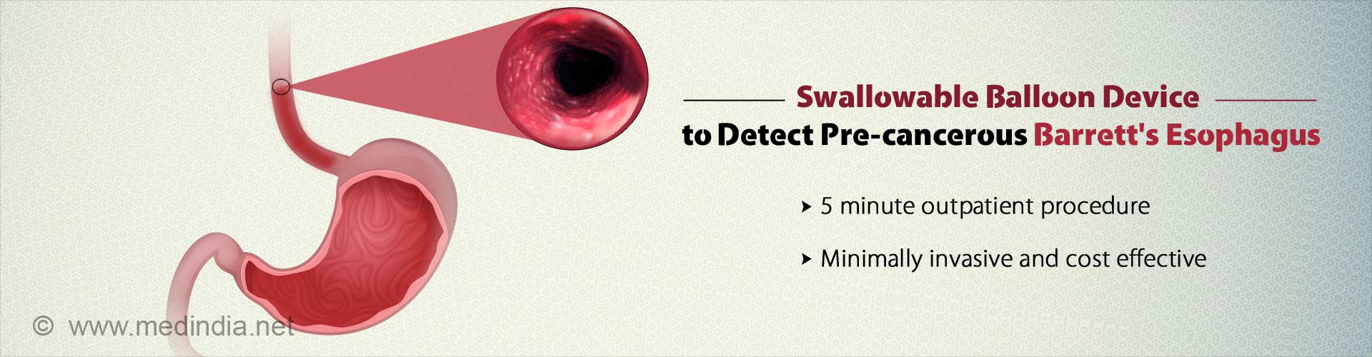 Swallowable balloon device to detect pre-cancerous Barrett's Esophagus
- 5 minute out-patient procedure
- Minimally invasive and cost-effective