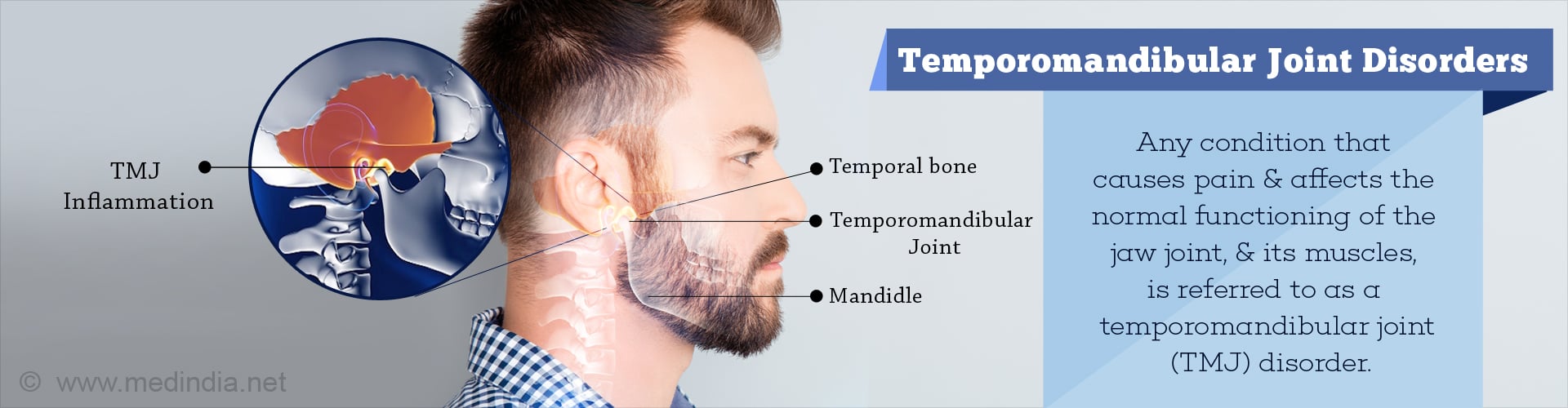 Temporomandibular Joint Disorder
Any condition that causes pain and affects the normal functioning of the jaw joint, and its muscles, is referred to as a Temporomandibular joint (TMJ) disorder
- TMJ inflammation
- Temporal bone
- Temporomandibular Joint
- Mandible