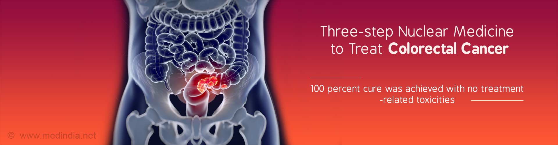 Three-step nuclear medicine to treat colorectal cancer
- 100 % cure was achieved with no treatment-related toxicities