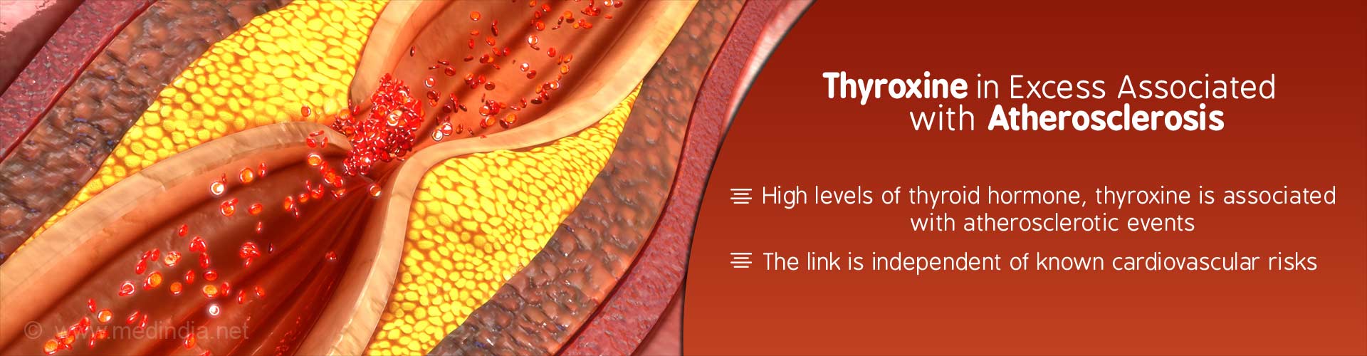 High Levels of Thyroid Hormone Associated With Artery Disease and Death