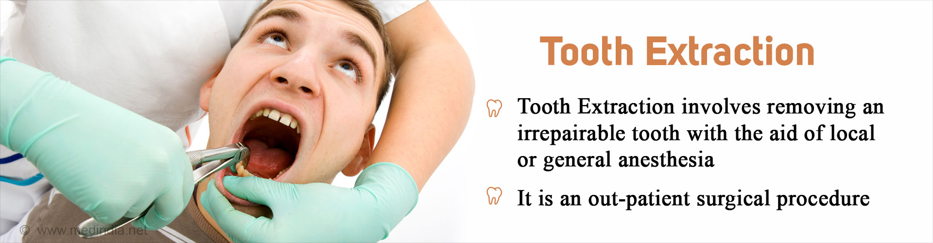 Tooth Extraction
- Tooth extraction is an out-patient surgical procedure
- It involves removing an irreparable tooth with the aid of local or general anesthesia