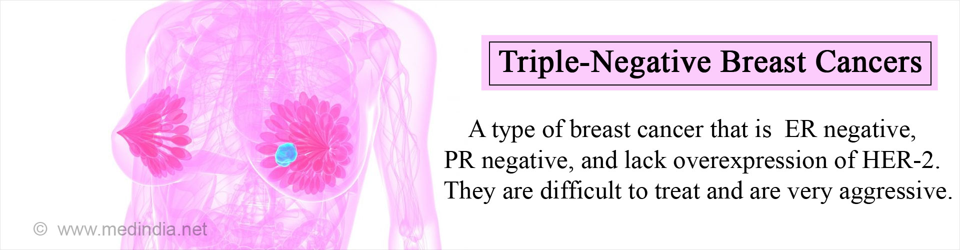 Triple-Negative Breast Cancer - A type of breast cancer that is ER negative, PR negative, and lack overexpression of HER-2. They are difficult to treat and are very aggressive.