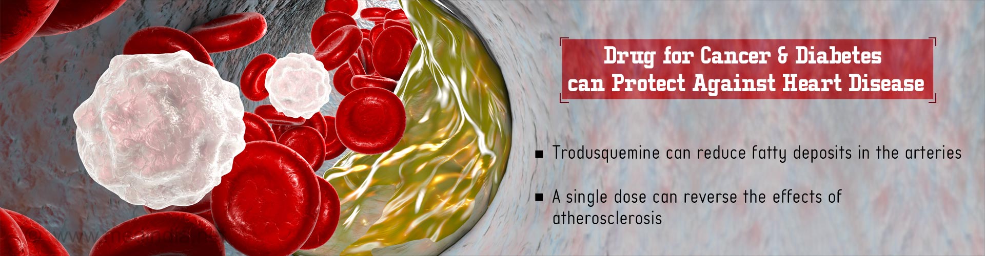 Drug for cancer & diabetes can protect against heart disease
- Trodusquemine can reduce fatty deposits in the arteries
- A single dose can reverse the effects of atherosclerosis