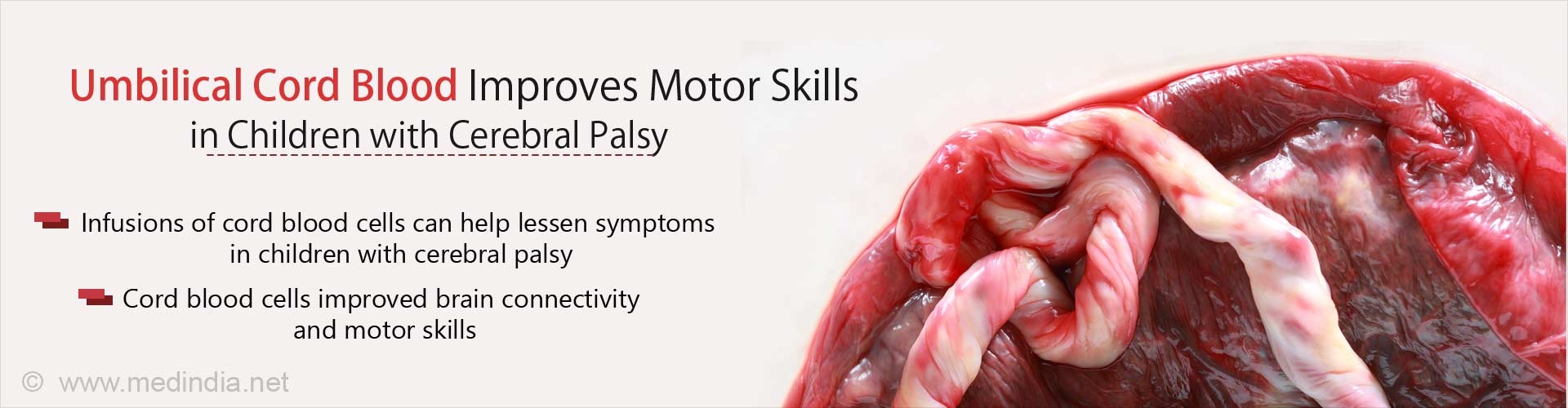 Umbilical Cord Blood Improves Motor Skills in Children with Cerebral Palsy