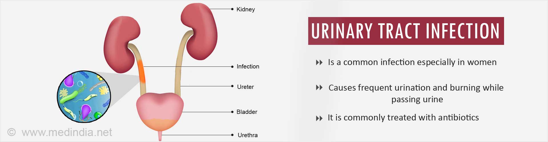 Urinary Tract Infection
- It is a common infection especially in women
- Causes frequent urination and burning while passing urine
- It is commonly treated with antibiotics