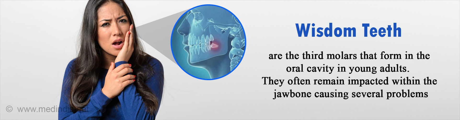 Wisdom teeth are the third molars that form in the oral cavity in young adults. They often remain impacted within the jawbone causing several problems.