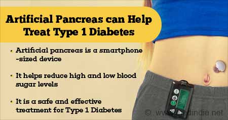 Artificial Pancreas ‘to Treat Type 1 Diabetes