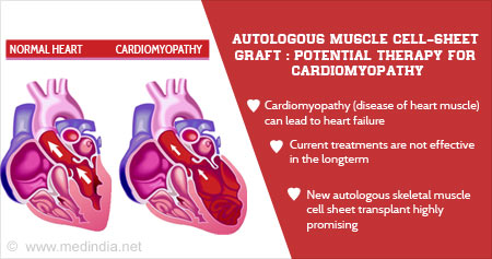 New Therapy For Cardiomyopathy