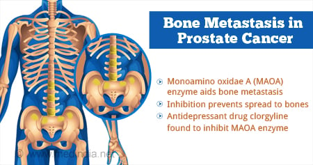 New Method that Prevents Bone Metastasis in Prostate Cancer Patients