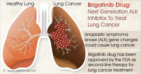 FDA Approved Brigatinib Drug For Lung Cancer Treatment