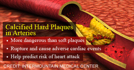 Dangers of Calcified Hard Plaques in Arteries