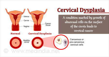 Cervical Dysplasia