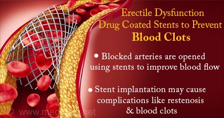 Stents to Prevent Blood Clots