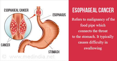 esophagus cancer