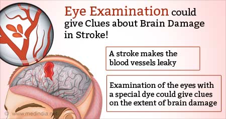 How Eye Examination Could Help in Detecting Brain Damage in Stroke Patients