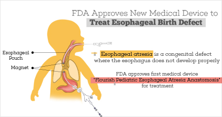 FDA Approved Medical Device for Esophageal Birth Defect