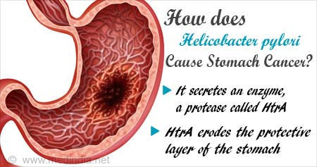 How Helicobacter Pylori Cause Stomach Cancer