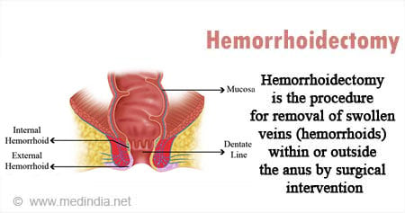Hemorrhoidectomy