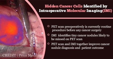 Cancer Cells Identified by Intraoperative Molecular Imaging (IMI)