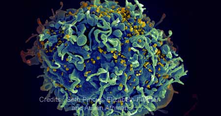 HIV Hiding Inside Patient's Cells Can Now be Measured Accurately