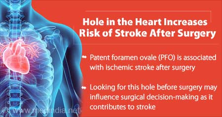 Hole in the Heart Increases Risk for Stroke After Surgery