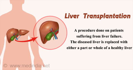 Liver Transplantation