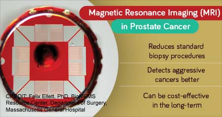 Magnetic Resonance Imaging (MRI) for Prostate Cancer