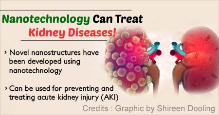 Nanotechnology Helps Treat Acute Kidney Injury