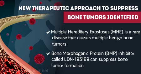 New Discovery for Treatment and Prevention of Bone Tumors