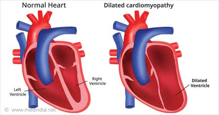 New Treatment Option Identified for Serious Heart Condition
