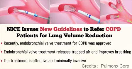 New COPD Management Guidelines from National Institute for Health and Care Excellence (NICE)