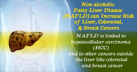 Nonalcoholic Fatty Liver Disease Increases Cancer Risk