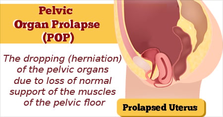 Pelvic Organ Prolapse - Types, Causes, Symptoms, Diagnosis, Treatment &  Prevention