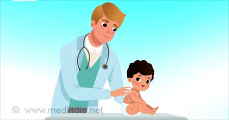 Vaccination: The Best Prevention Method for Measles