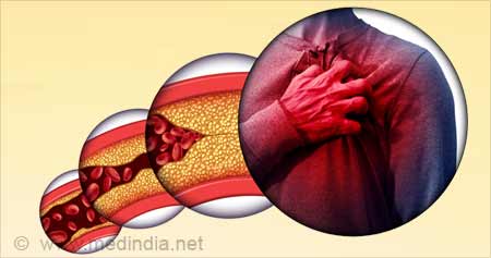 Psoriasis Therapy can Reduce Coronary Inflammation