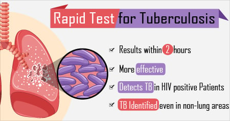 New Test for Early Identification of Tuberculosis
