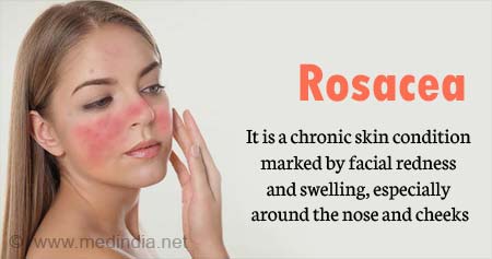 Rosacea