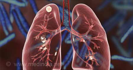 Tuberculosis Treatment May Now Become Shorter