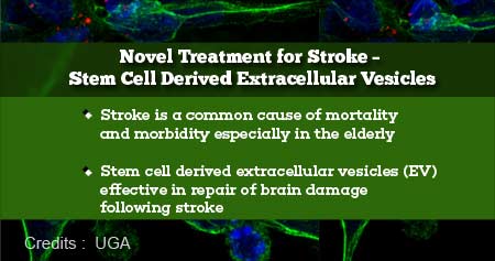 Stem Cell-Based Treatment for Stroke