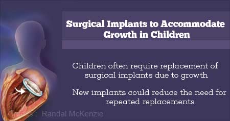 New Implants to Accommodate Growth in Children