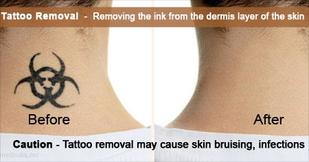 Laser Tattoo Removal in Kolkata  Lizards Skin Tattoo Parlour